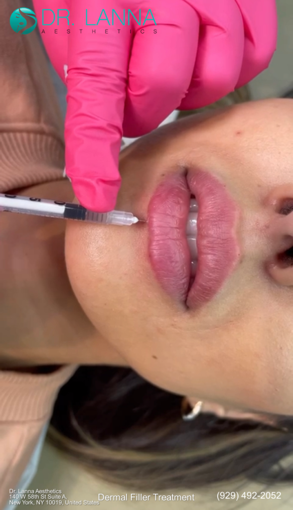 woman get dermal fillers on Dr. Lanna and shewill see them when she was watched.