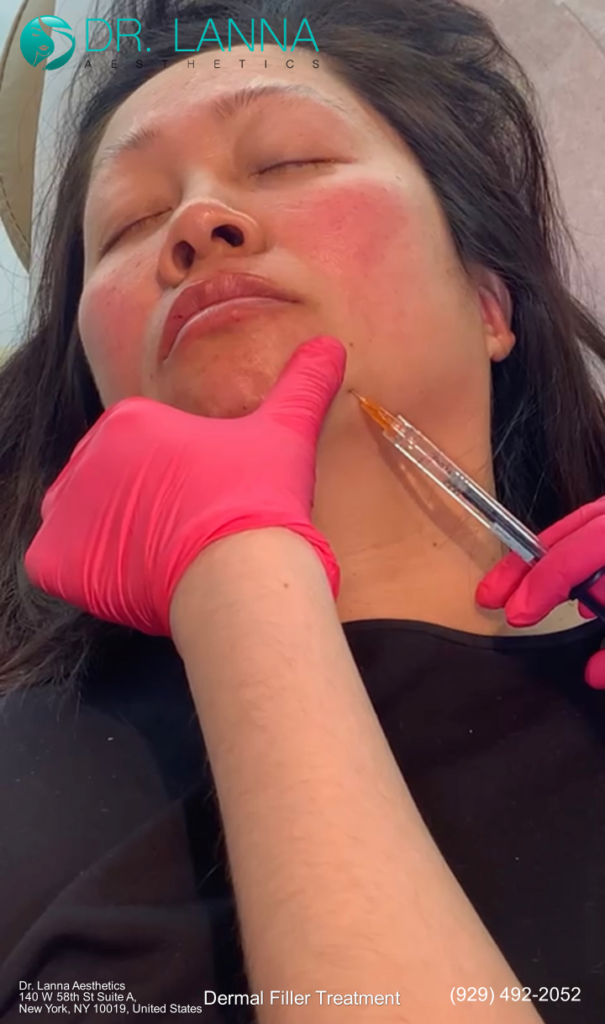 a woman who had jaw and chin filler treatment in a clinic