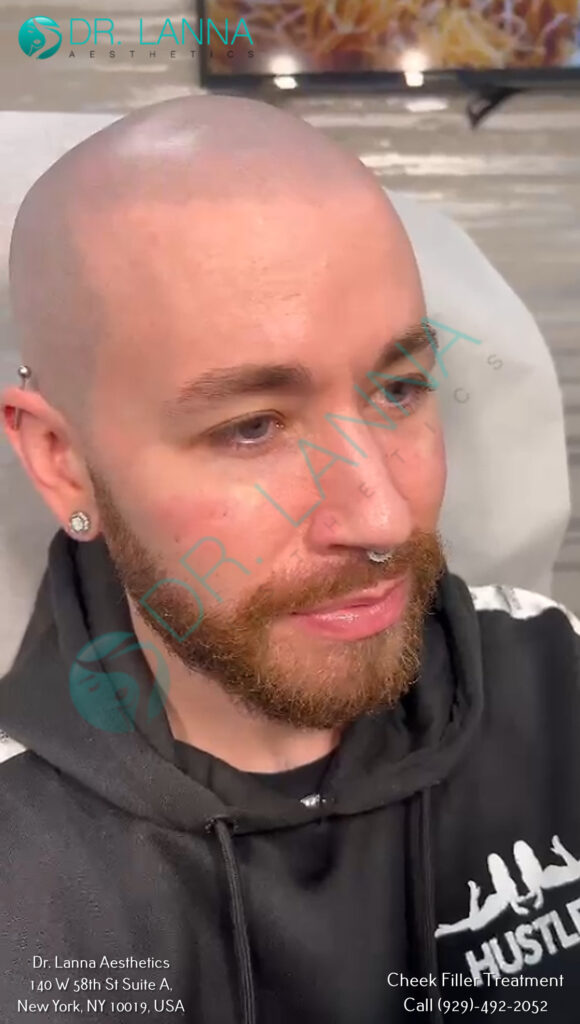 Bearded male cheek filler client portrait at Dr. Lanna Aesthetics in New York