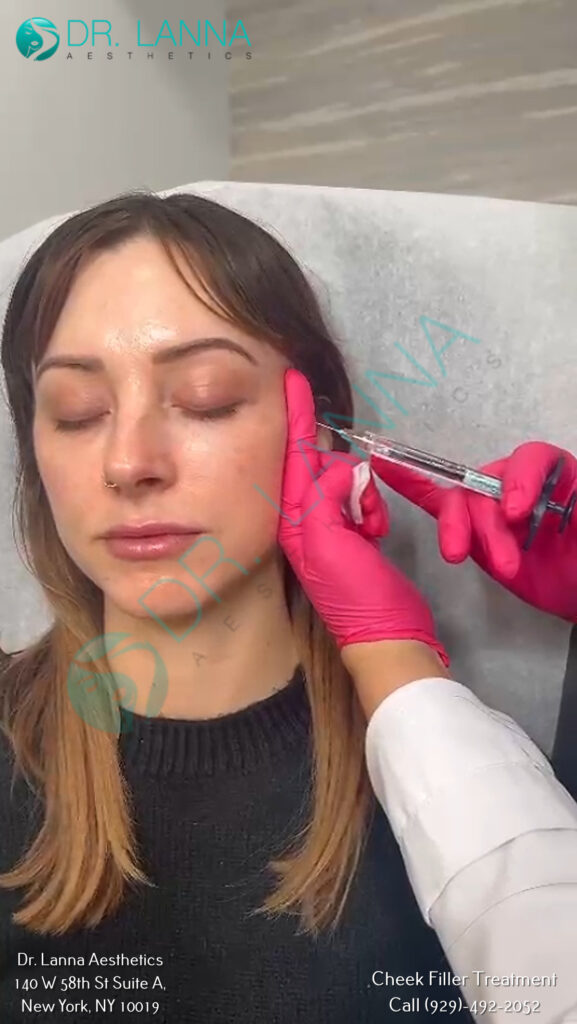Client receiving a cheek filler injection at Dr. Lanna Aesthetics, NYC