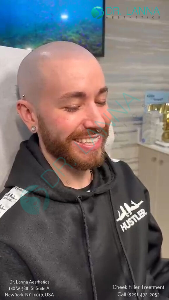 Bearded male cheek filler client at Dr. Lanna Aesthetics in New York