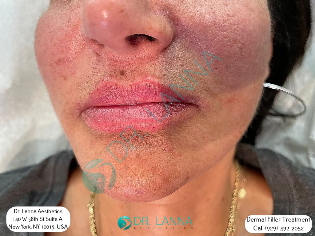 Close-up of a cheek filler client's lower face at Dr. Lanna Aesthetics in New York
