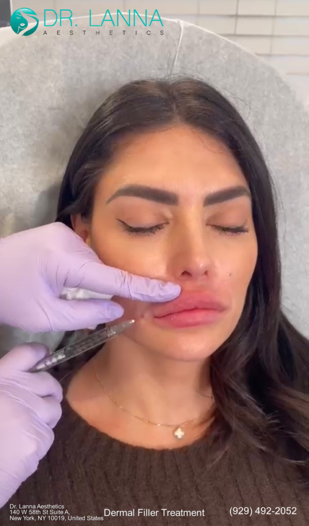 a woman had nasolabial dermal filler procedure at Dr. Lanna's clinic
