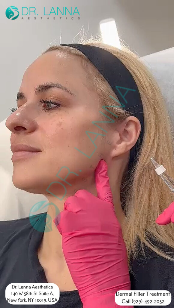 Client receiving a dermal filler injection in profile at Dr. Lanna Aesthetics, NYC