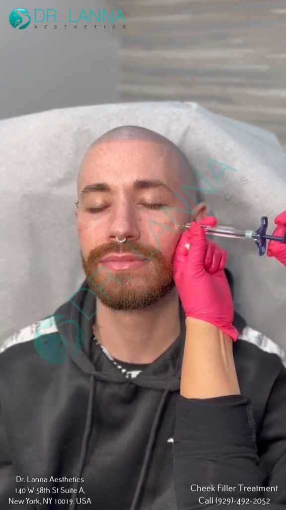 cheek filler treatment