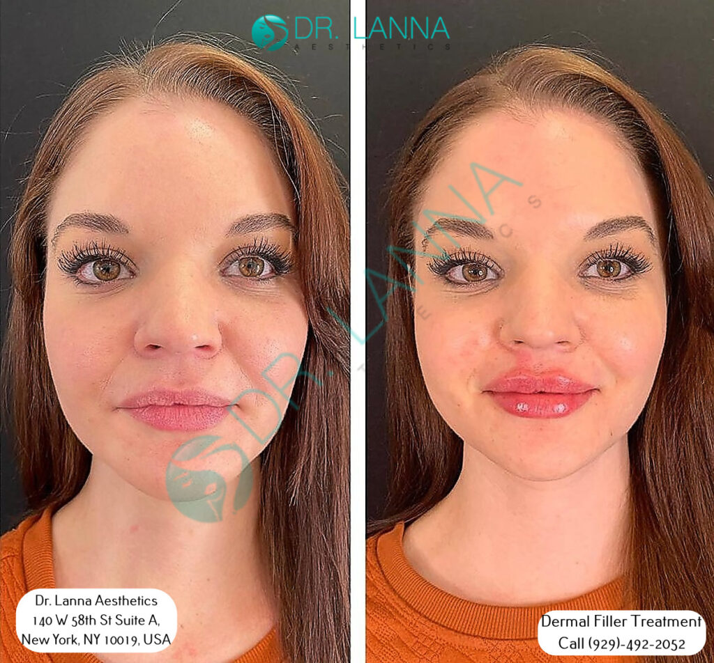 Before and after dermal filler result at Dr. Lanna Aesthetics in New York
