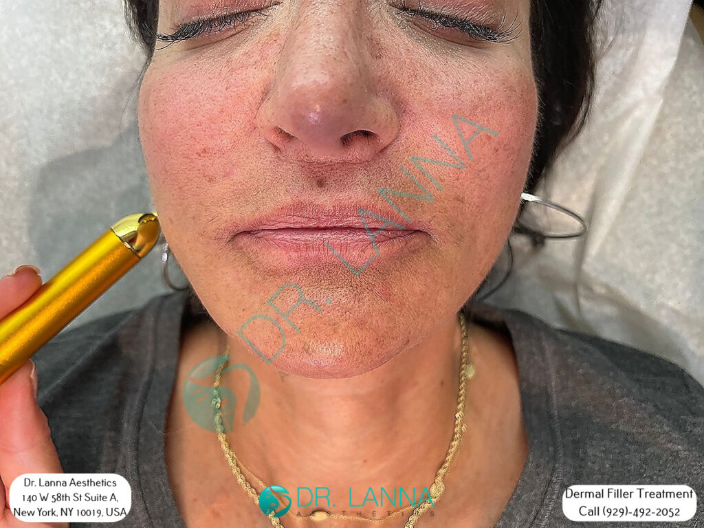 Close-up of a dermal filler client's lower face at Dr. Lanna Aesthetics in New York