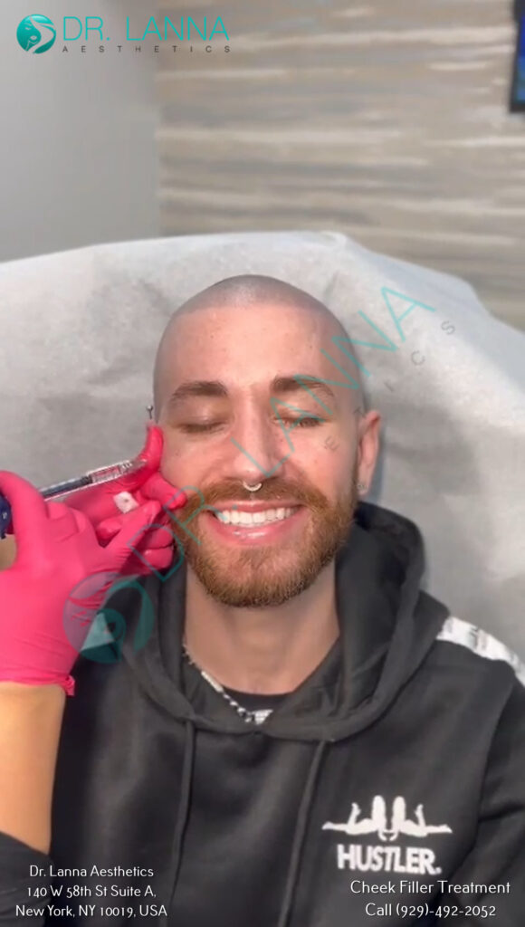 cheek filler results