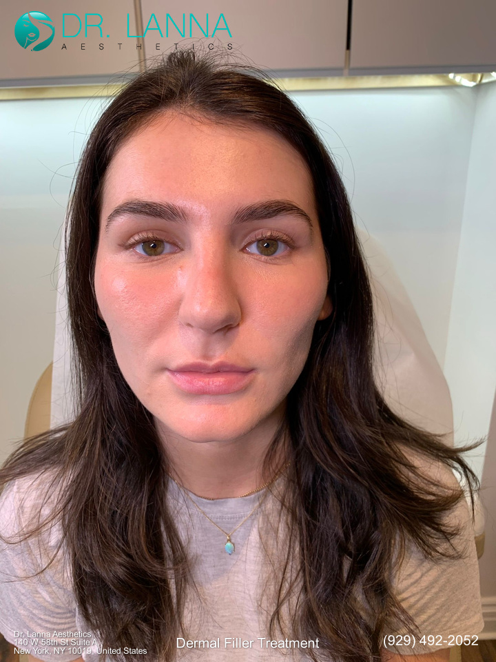 treatment results on a woman who had a chin filler procedure inside a beauty clinic