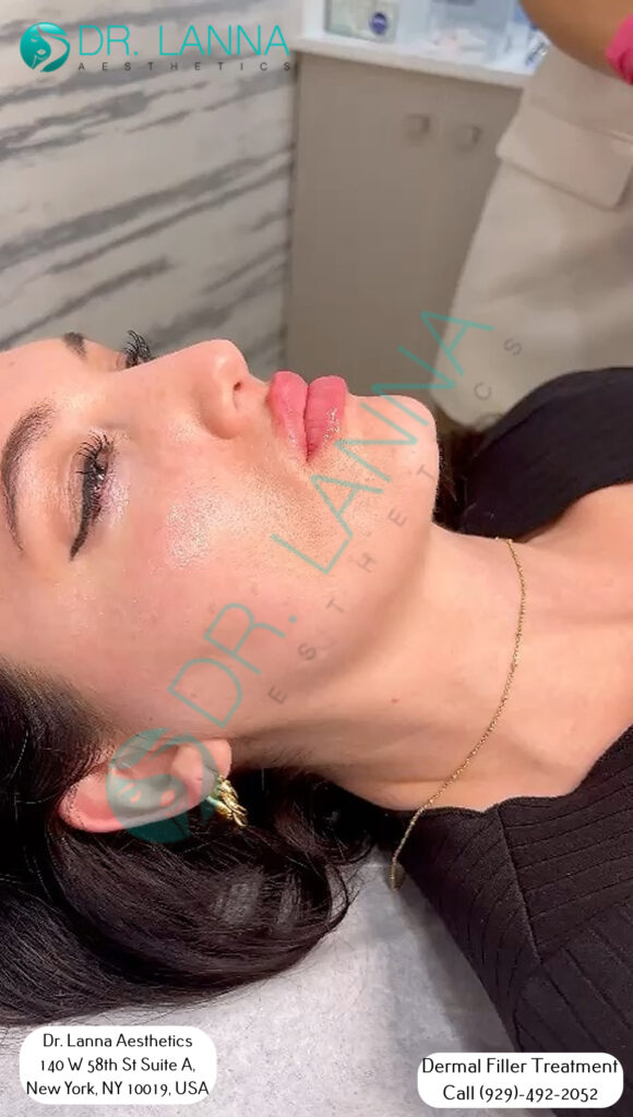 a patient received cheek filler treatment at Dr. Lanna's clinic