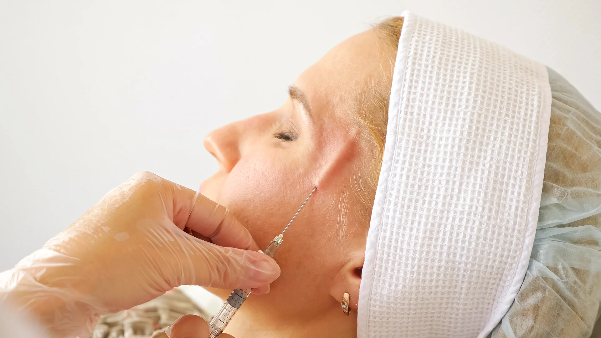 a woman had temple filler injection||