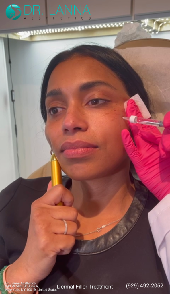 a woman had dermal filler treatment on her cheeks at Dr. Lanna's clinic