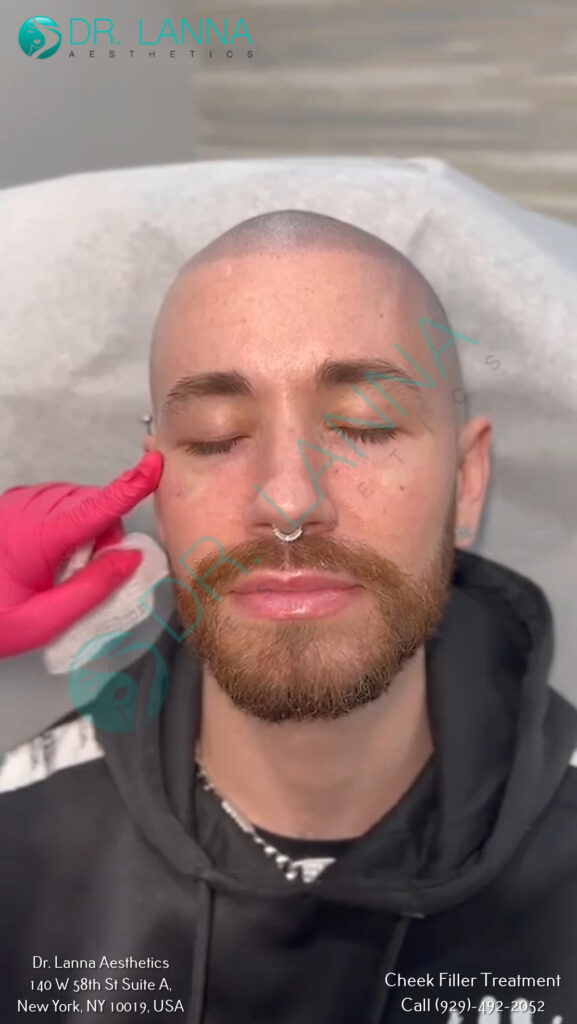 Cheek Filler Treatment at Dr. Lanna Aesthetics