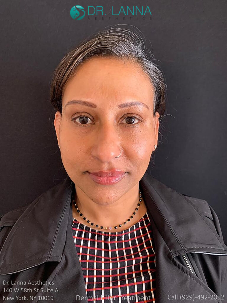 woman received cheek filler treatment in a beauty clinic