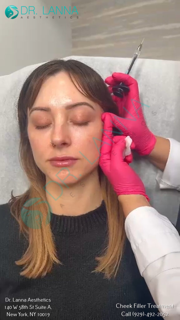 cheek filler treatment