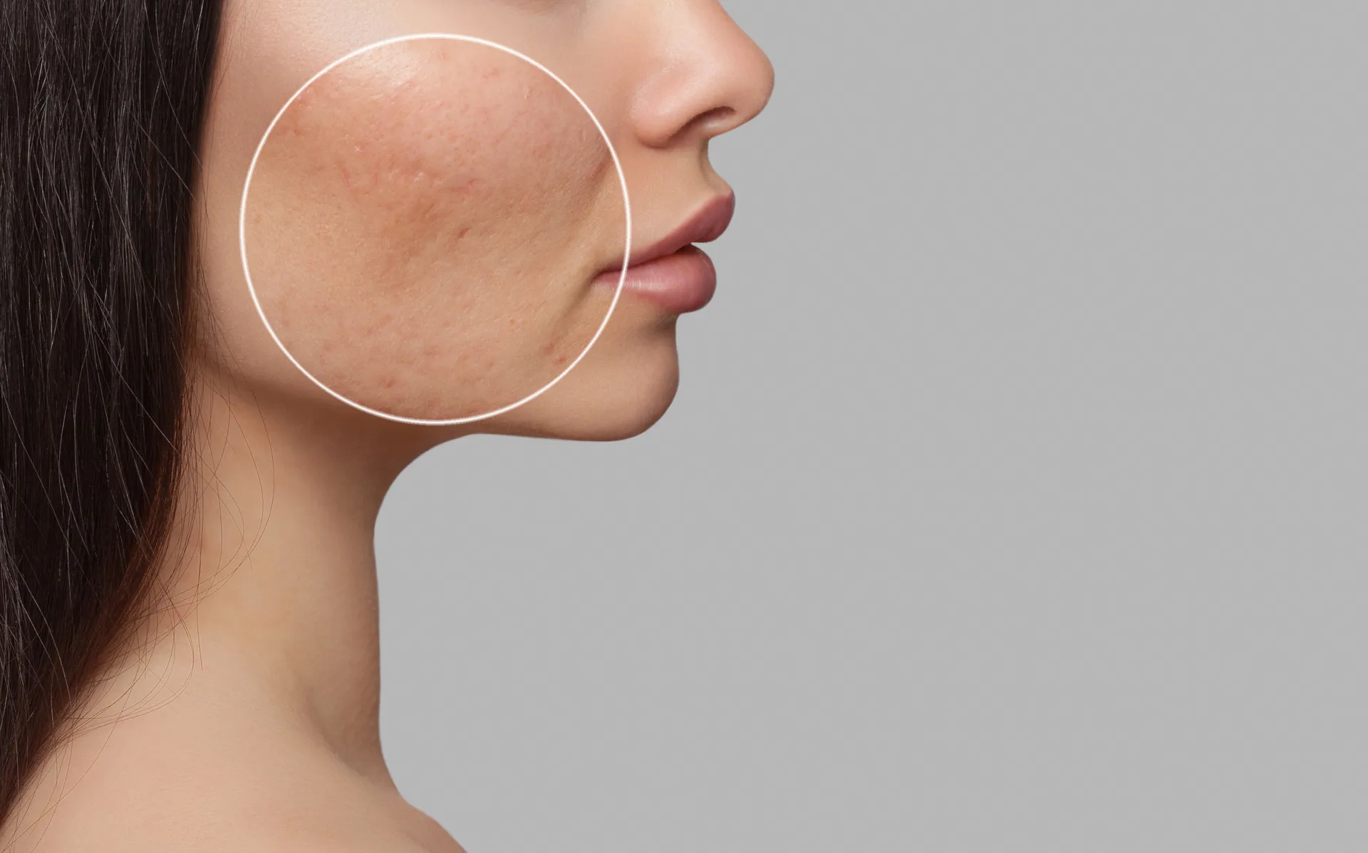 Acne Scar Removal in NYC