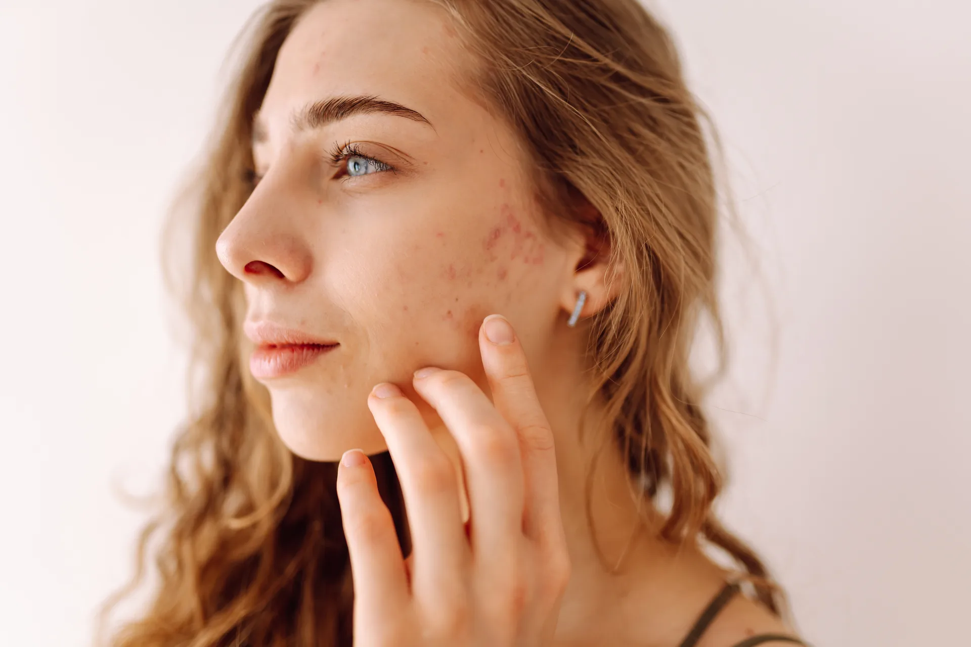 Acne Scar Removal technique